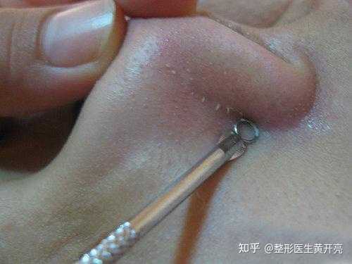 这是黑鼻头吗，怎么祛除?