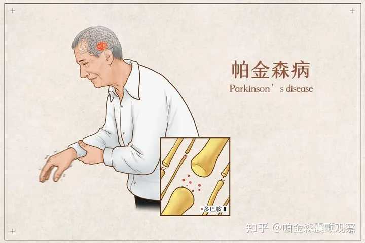 帕金森 是什么病有什么症状 知乎 9107