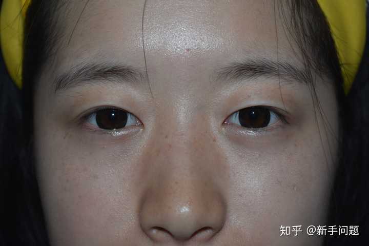 想知道有没有在福建省立医院丁力医生那里做过双眼皮的姐妹显示全部