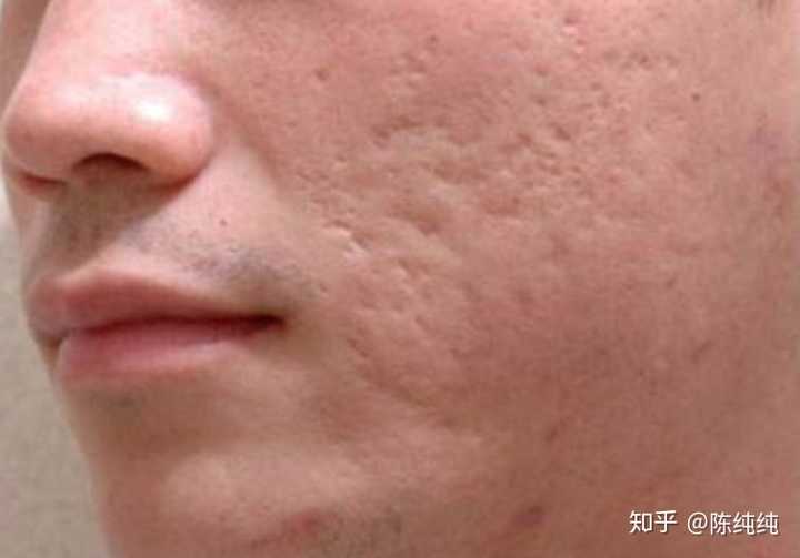 长的痘痘到底该不该挤 知乎