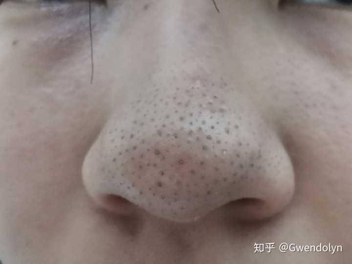 男士去黑头效果好的的护肤产品什么比较好 知乎 男士去黑头效果好的的护肤产品什么比较好 知乎