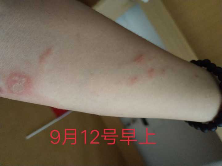 谁告诉我这是被什么咬了