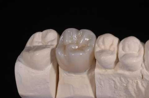 有些人在遇到要做牙冠的时候都会纠结,好不容易决定做全瓷牙,但面对不