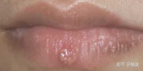 嘴角起泡如何处理可以最短时间痊愈 知乎 嘴角起泡如何处理可以最短时间痊愈 知乎