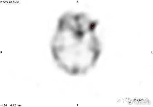 SPECT和PET和CT有什么区别，相比其他两者，SPECT有什么优势？ - 知乎