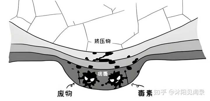挤压综合征是如何形成的？ - 知乎