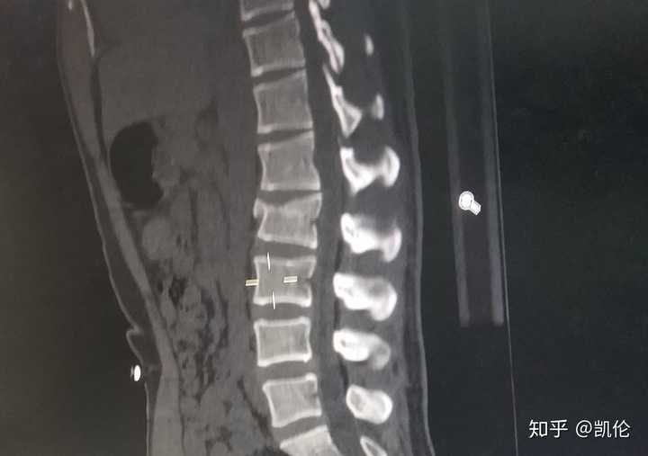 腰椎骨折是怎样的体验 治疗过程是怎样的 多久可以恢复 知乎