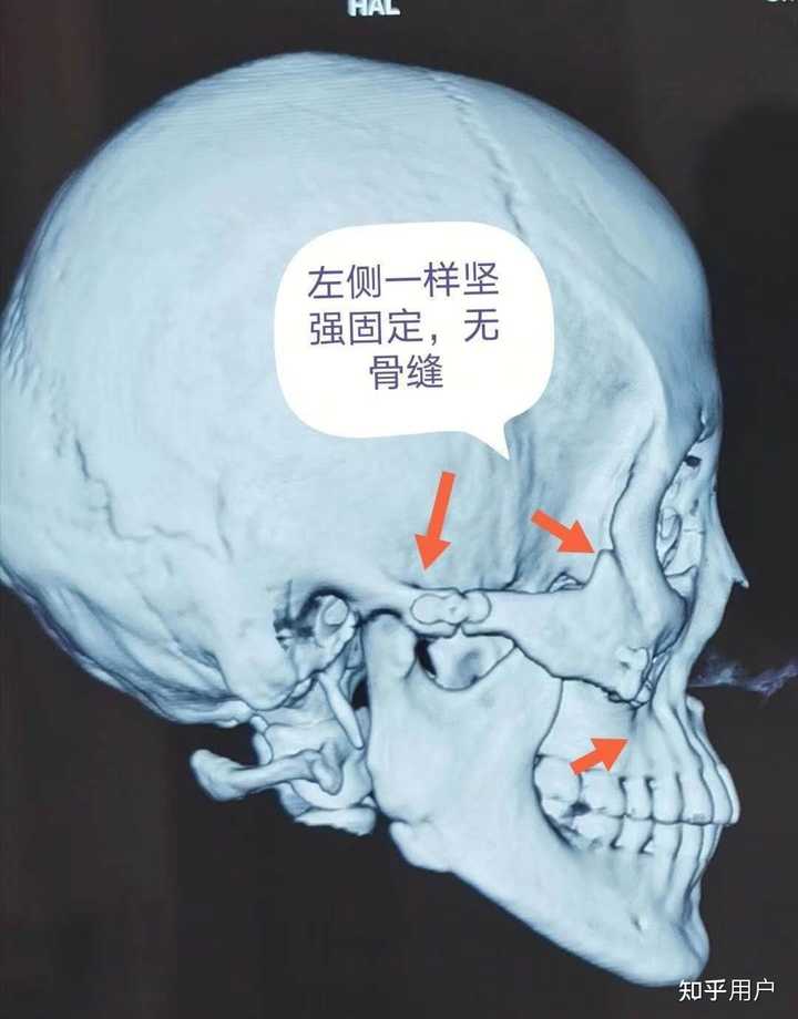 颧骨和颧弓有什么区别,颧弓外扩和颧骨高对脸型分别是什么样的影响? - 知乎