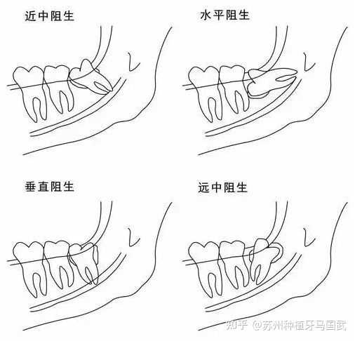 拔完智齿脸为什么会肿 知乎