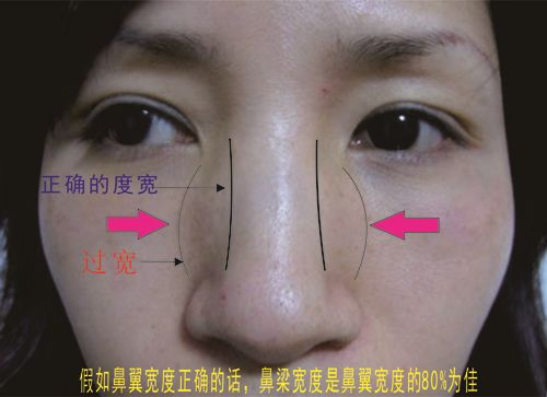 有鼻骨宽的做鼻骨内推手术的吗 知乎 有鼻骨宽的做鼻骨内推手术的吗 知乎