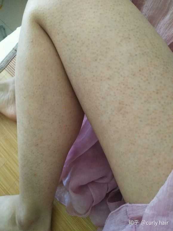 胯部有鸡皮肤(胯两侧有鸡皮疙瘩)