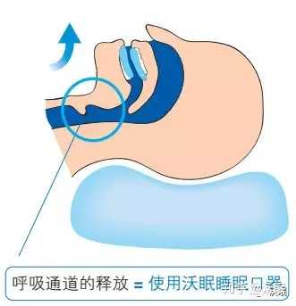 止鼾器是否真的管用 那一种类型的止鼾器管用呢 知乎