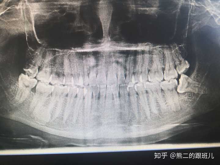 眉尾骨连着太阳穴疼 上眼眶眉骨按压疼 眼眶眉毛处按压胀痛