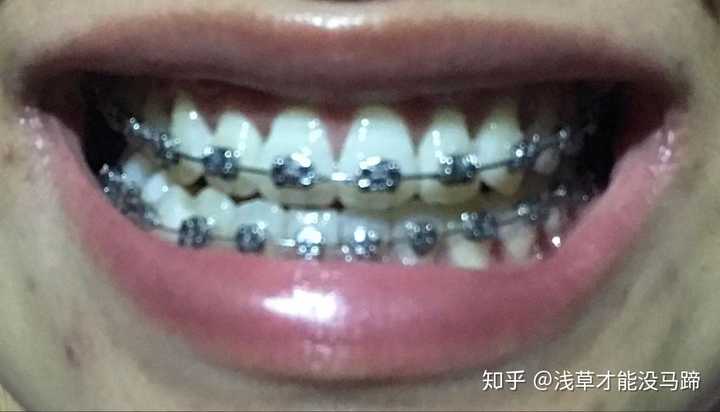 现在武大口腔医院成人正畸大概费用是多少 知乎