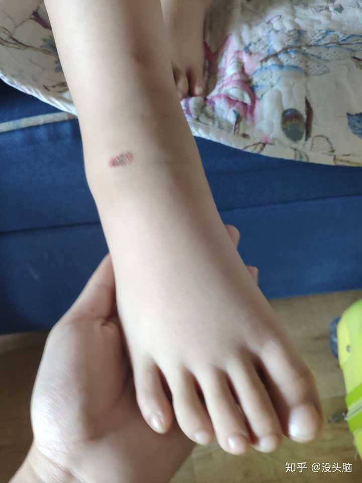 求助 你们有被蚊子叮过后 整个手或胳膊特别肿大的经历么 知乎