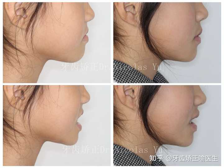 整牙成功是什么体验 知乎