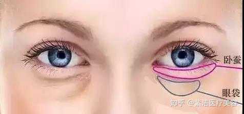 什么是 卧蚕 它跟眼袋有什么区别 知乎