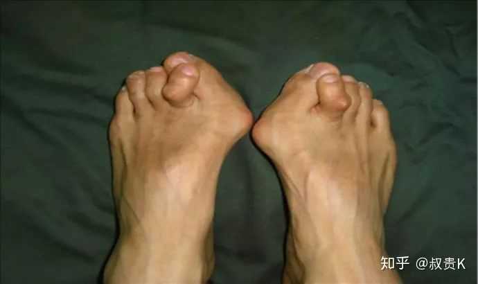 再严重下去,两个大拇脚指下面的就会突起红疙瘩——拇囊炎