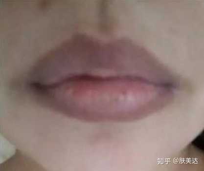下嘴唇两侧暗沉 可以看见明显的黑块 像是大块的斑 是什么原因呢 如何改善 知乎 下嘴唇两侧暗沉 可以看见明显的黑块 像是大块的斑 是什么原因呢 如何改善 知乎