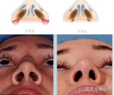 鼻骨内推和鼻头鼻翼缩小有多大风险 知乎 鼻骨内推和鼻头鼻翼缩小有多大风险 知乎