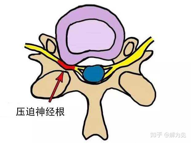 颈椎病可以恢复吗 知乎