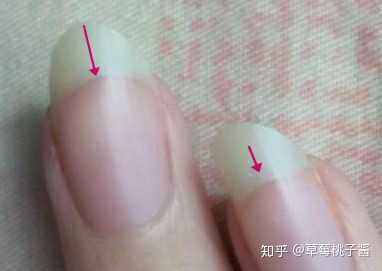 指甲缝太深能恢复吗? - 知乎