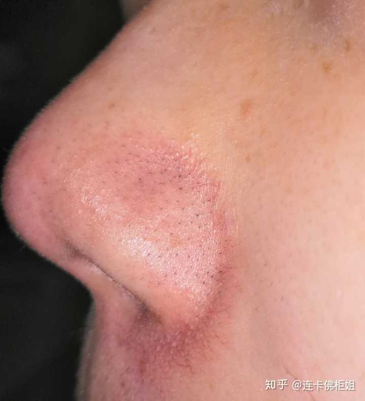 鼻子上长黑毛还挺重的,鼻翼两边都是,怎么办,挺绝望的.