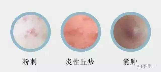 冒白头的痘痘是挤破好还是不挤破好？ - 知乎