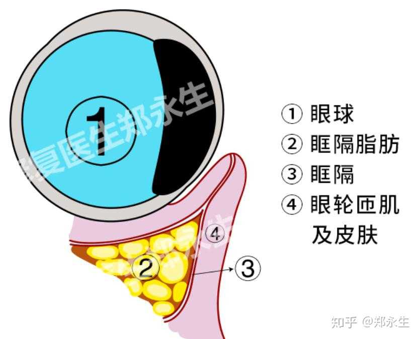 详解眶隔与眶隔脂肪