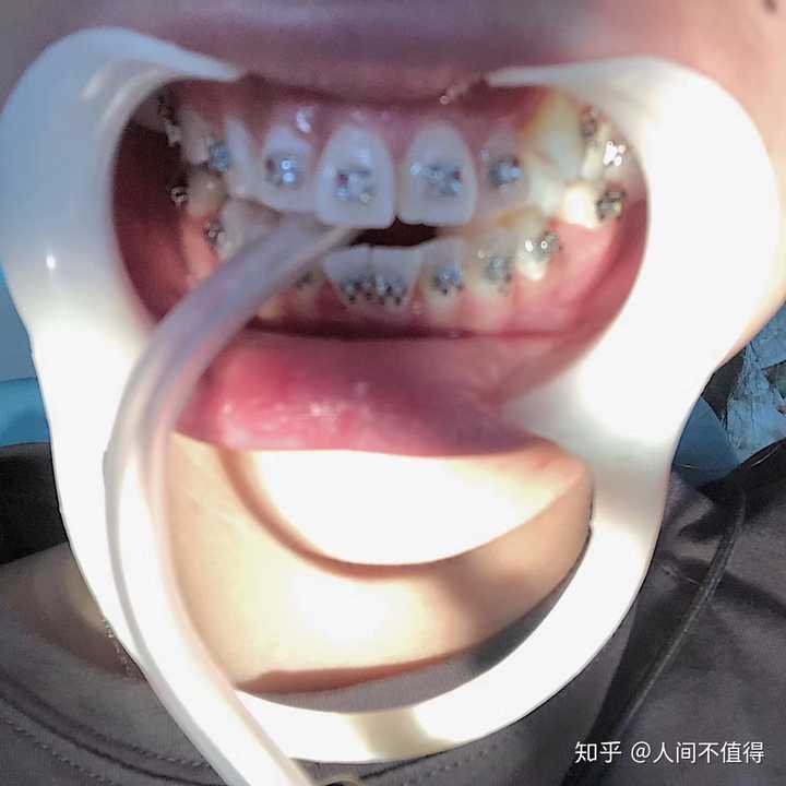 戴牙套有什么难受的事 知乎