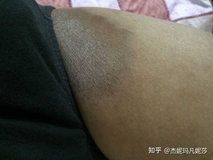 大腿内侧发黑，很痒，是什么情况?