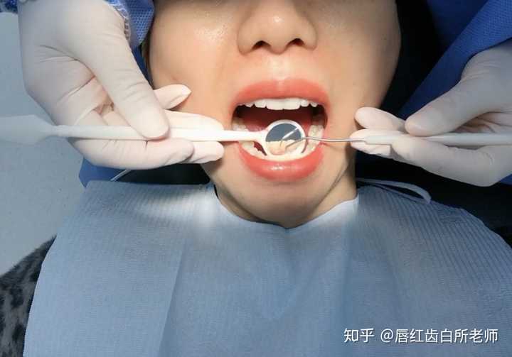洗牙一般多少钱一次 知乎 洗牙一般多少钱一次 知乎