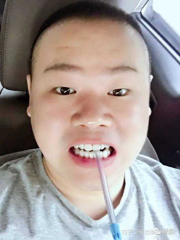 很多明星变漂亮都说整了牙成年人整牙真的会对外貌变化很大吗