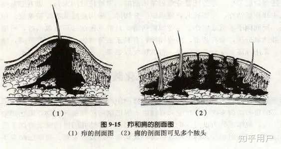火疖子的病因是什么? - 知乎