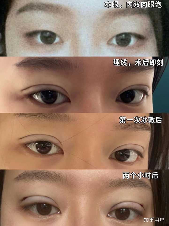 埋线法双眼皮价格_双眼皮埋线价格_双眼皮法埋线价格多少
