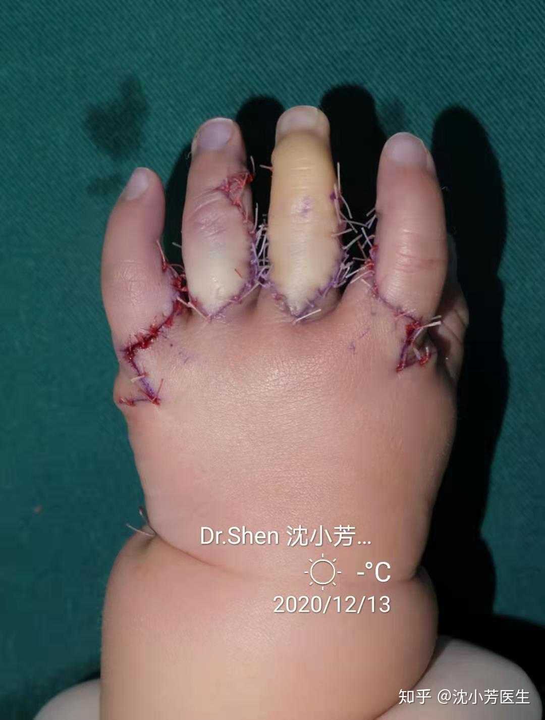 波兰综合征