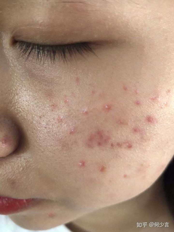 尤其是我一吃火锅啊,辣条儿啊,第二天绝对满脸痘痘!
