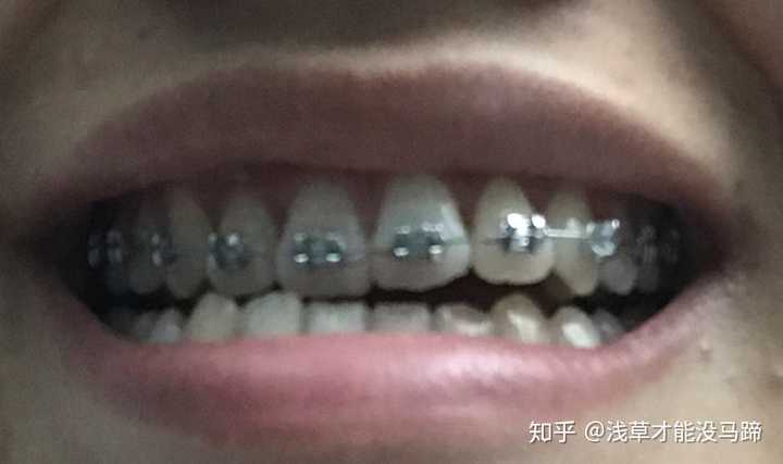 现在武大口腔医院成人正畸大概费用是多少 知乎