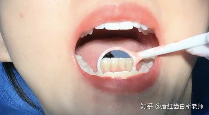 洗牙一般多少钱一次 知乎 洗牙一般多少钱一次 知乎