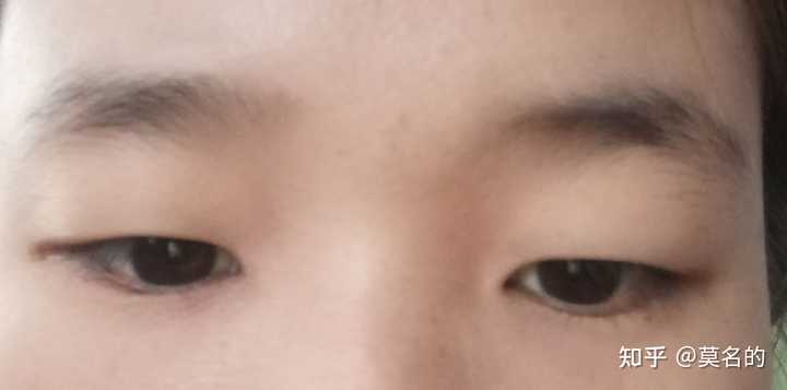 下眼袋突然肿起来是什么回事 知乎