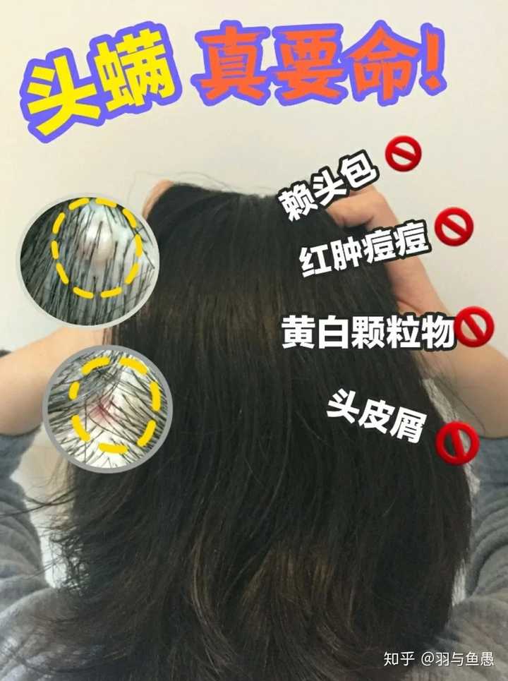 头发有螨虫 怎么除去 知乎