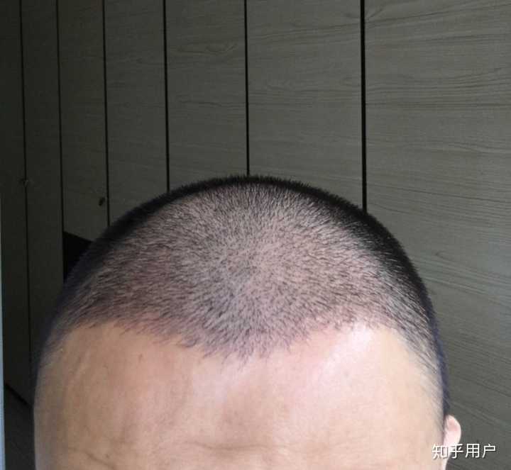 26岁就秃了是种什么体验? - 知乎