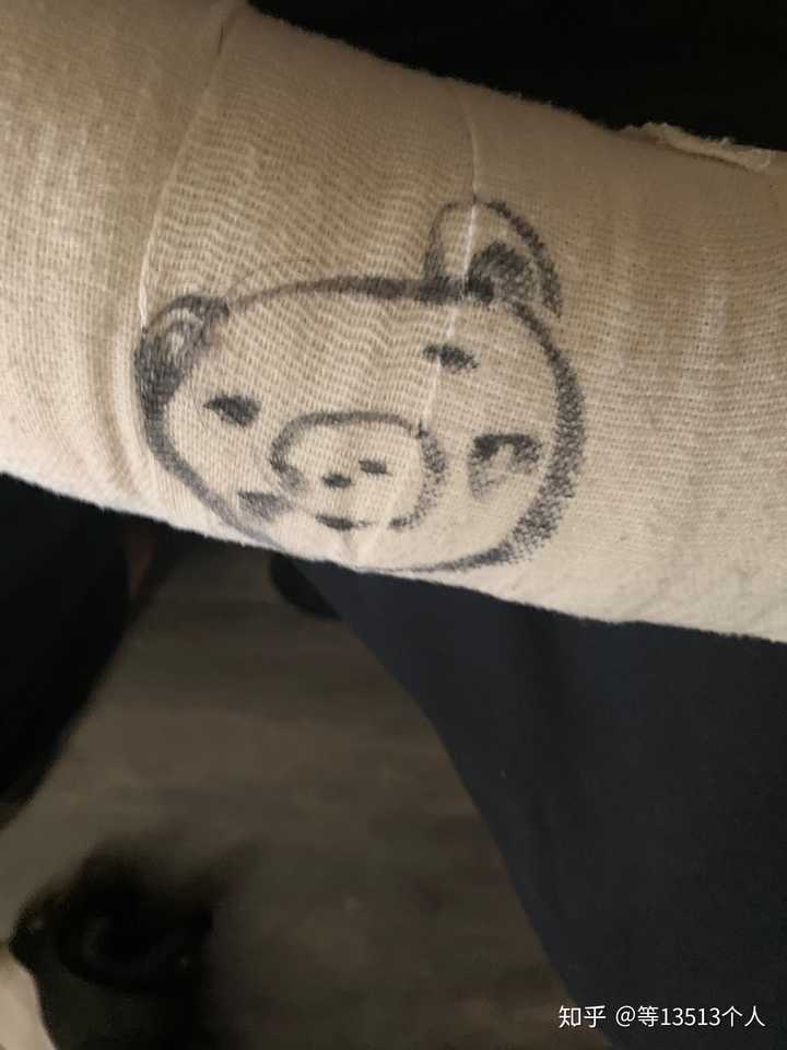 是胳膊骨折了…别人在我石膏上画的自画像
