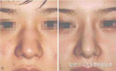 有鼻骨宽的做鼻骨内推手术的吗 知乎 有鼻骨宽的做鼻骨内推手术的吗 知乎
