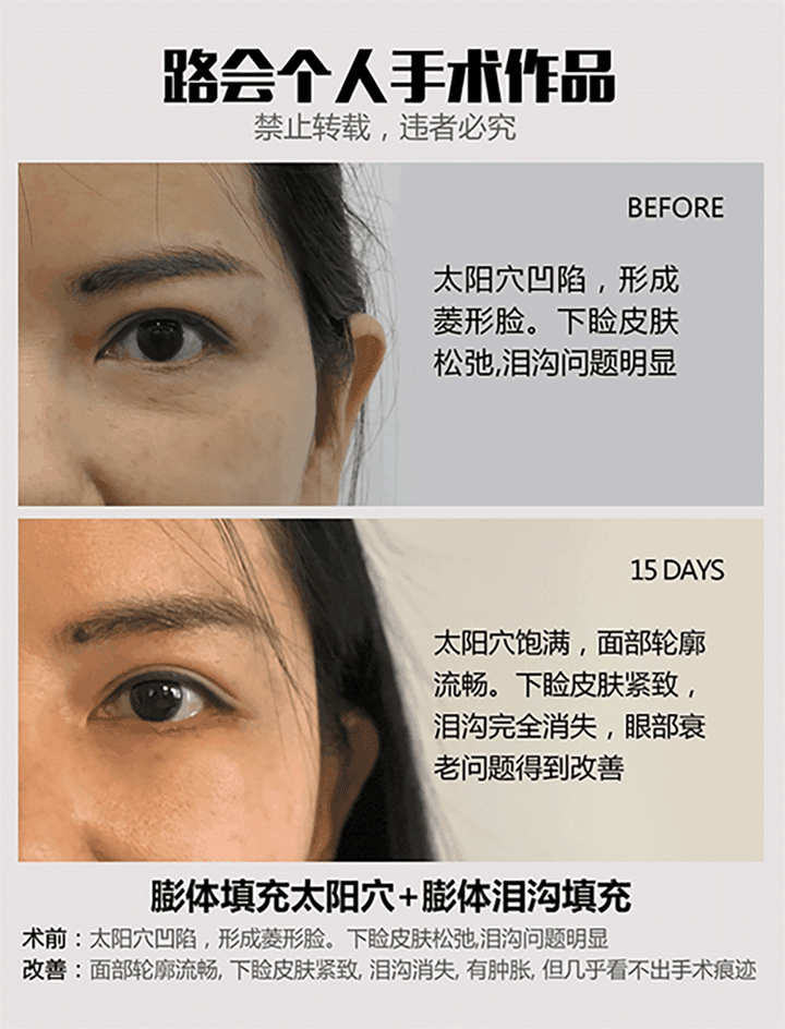 面部凹陷怎么办? - 知乎