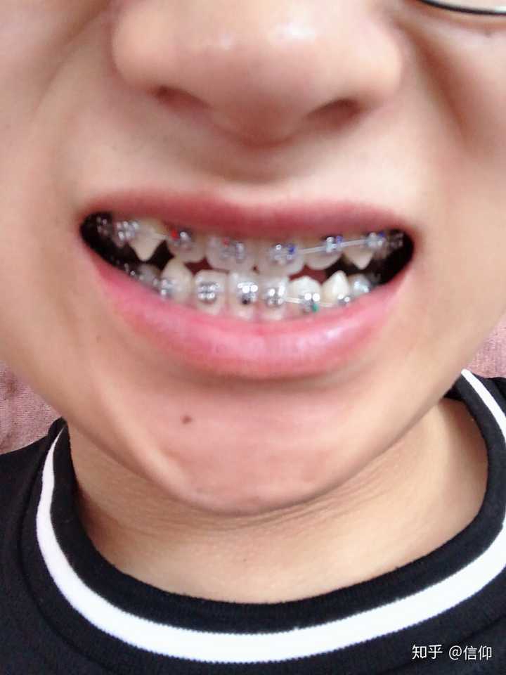 你们戴牙套多少天了？
