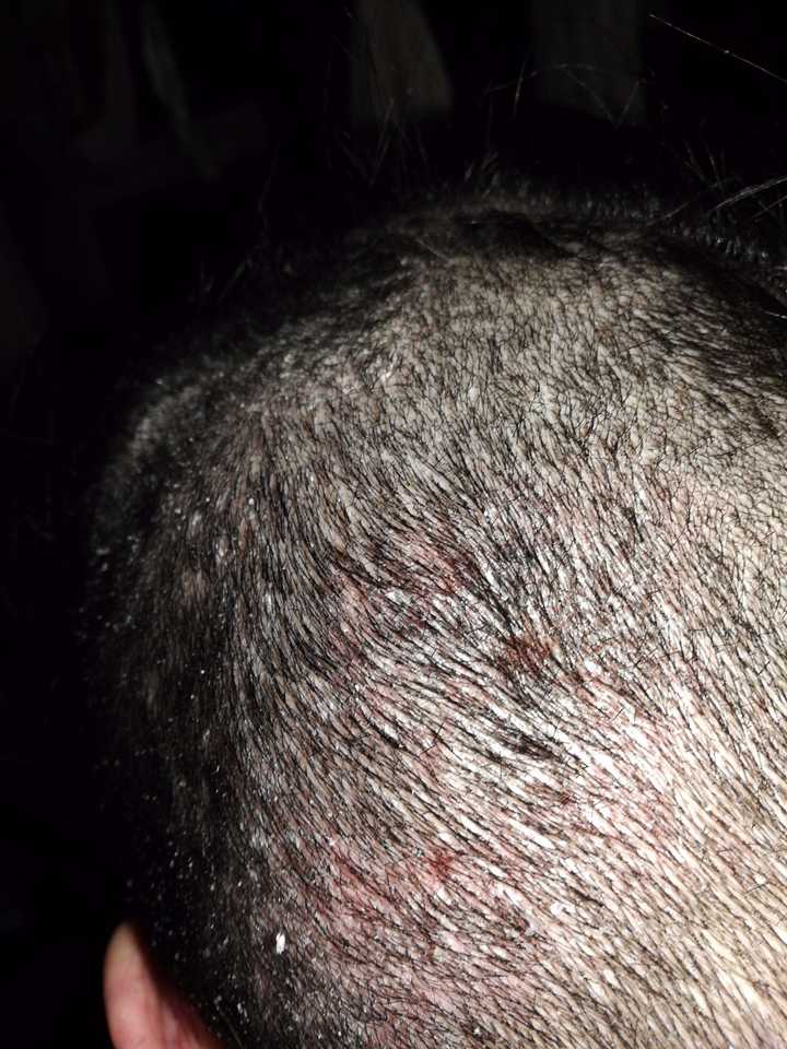 头发皮脂炎的症状图片图片