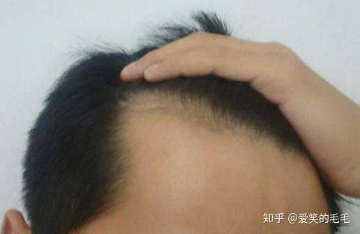 M型脱发该如何拯救 知乎 M型脱发该如何拯救 知乎