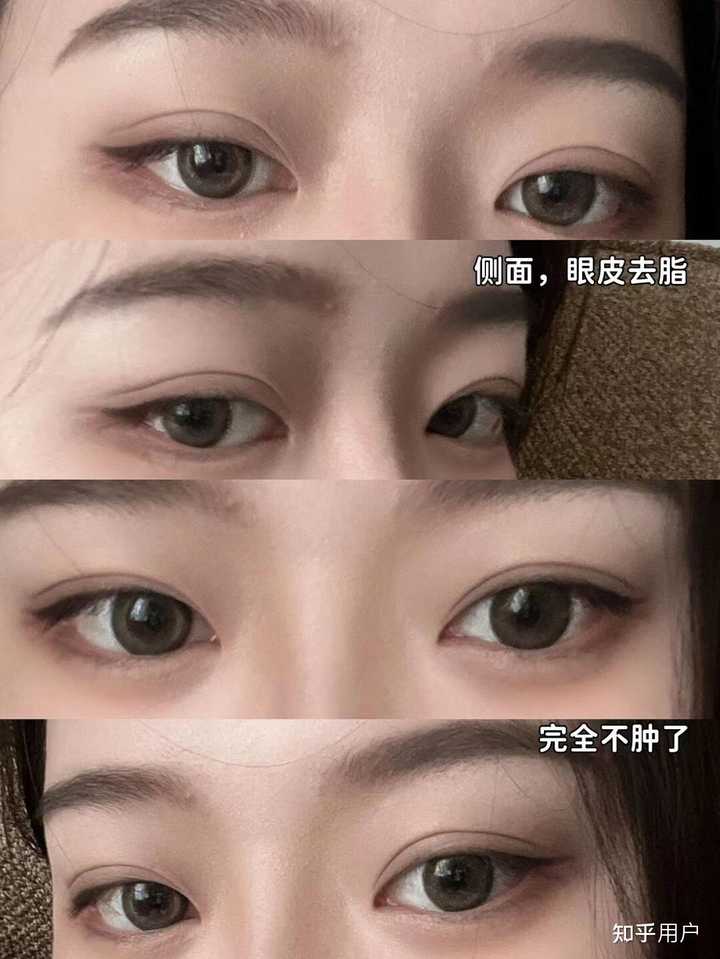 双眼皮埋线价格_埋线法双眼皮价格_双眼皮法埋线价格多少