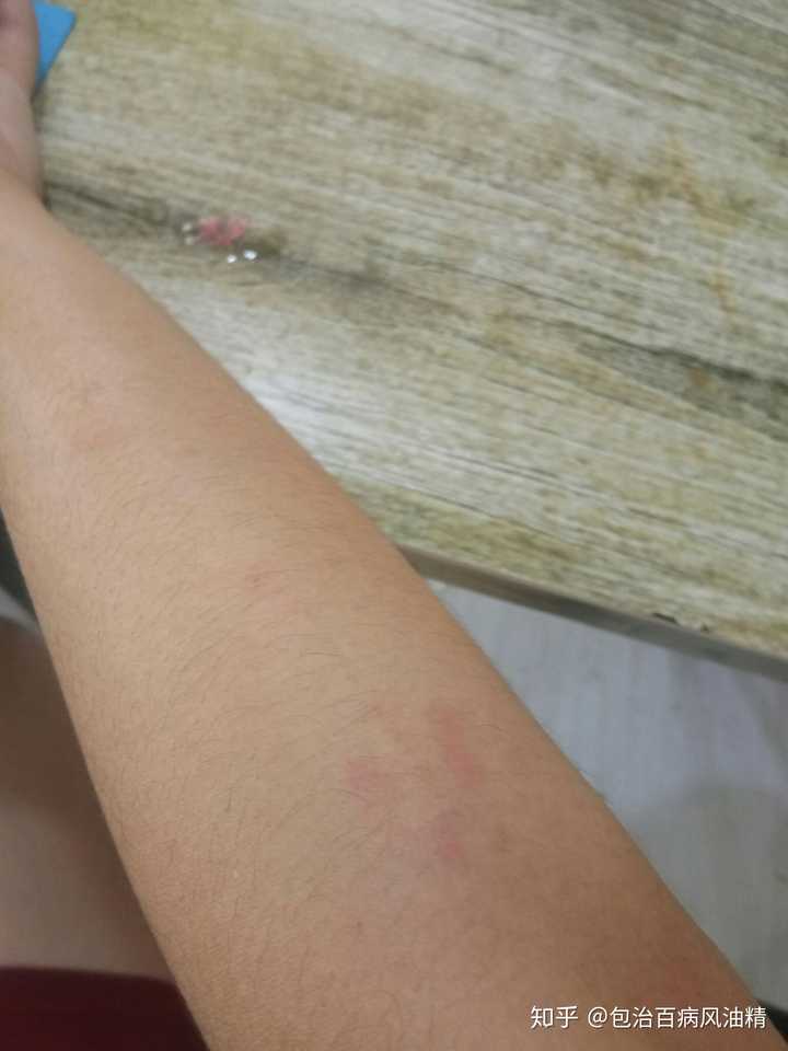 紫外线过敏日光性皮炎是一种怎样的感受